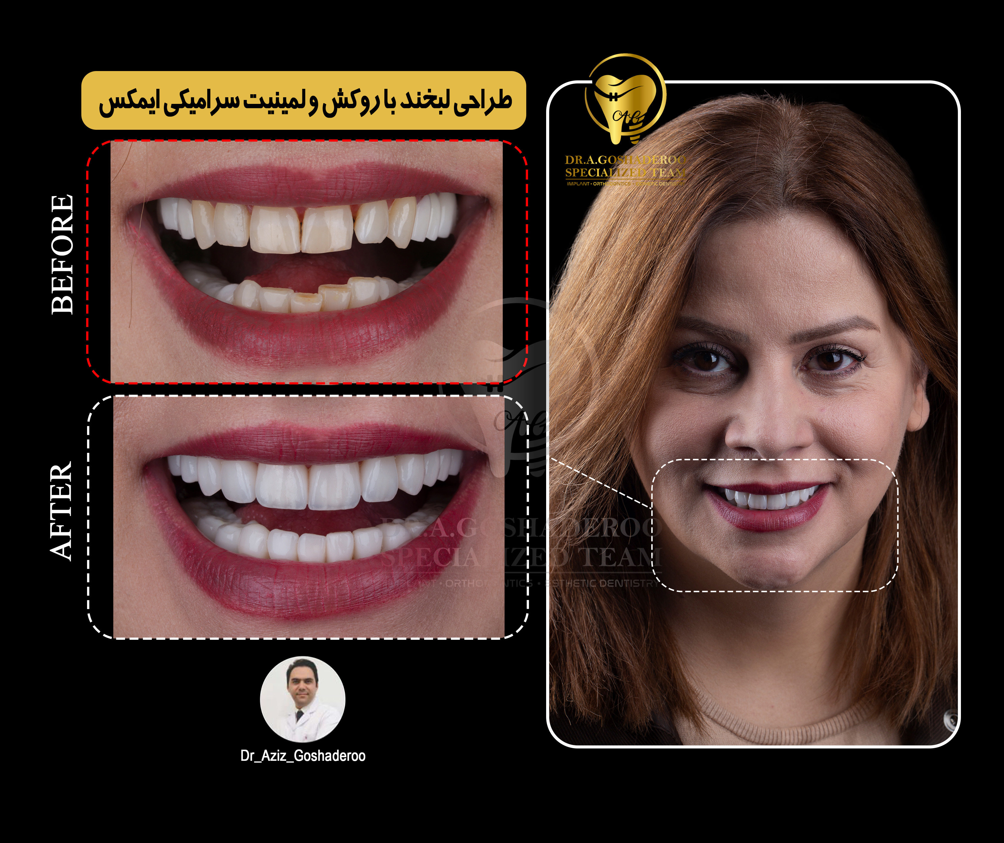 طراحی لبخند با روکش سرامیکی