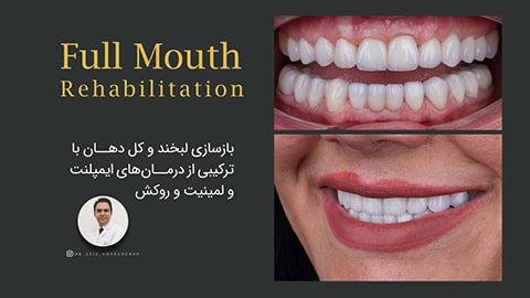 بازسازی لبخند و کل دهان با درمان های ترکیبی