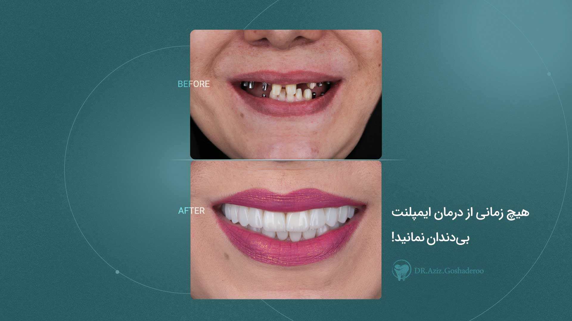 صفر تا صد ایمپلنت دندان