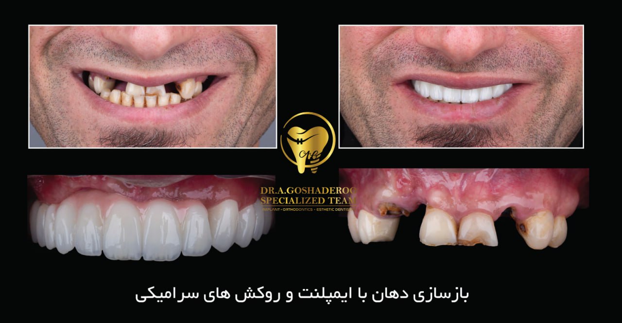 آیا All-on-4 بدون پیوند استخوان انجام می‌شود؟