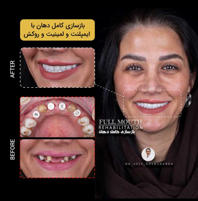 ایمپلنت دندان چیست؟