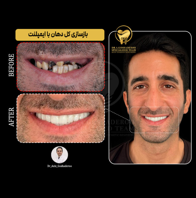 ایمپلنت دیجیتالی