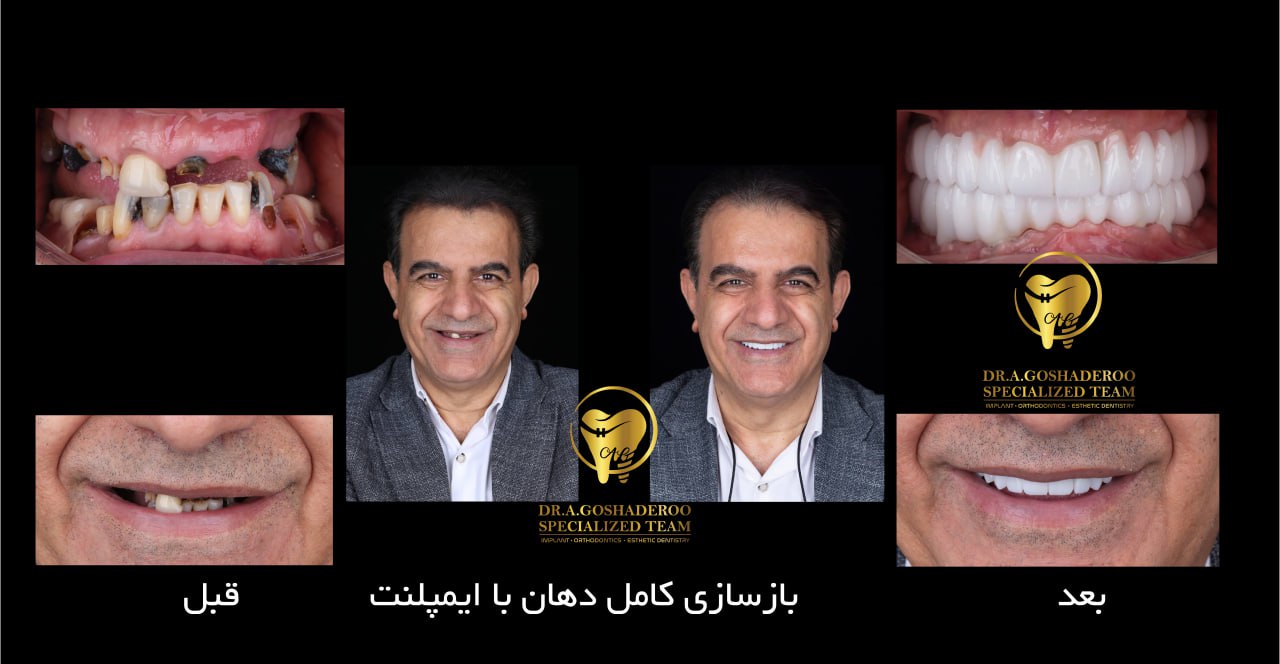 ایمپلنت دندان چیست و چه زمانی به آن نیاز داریم؟