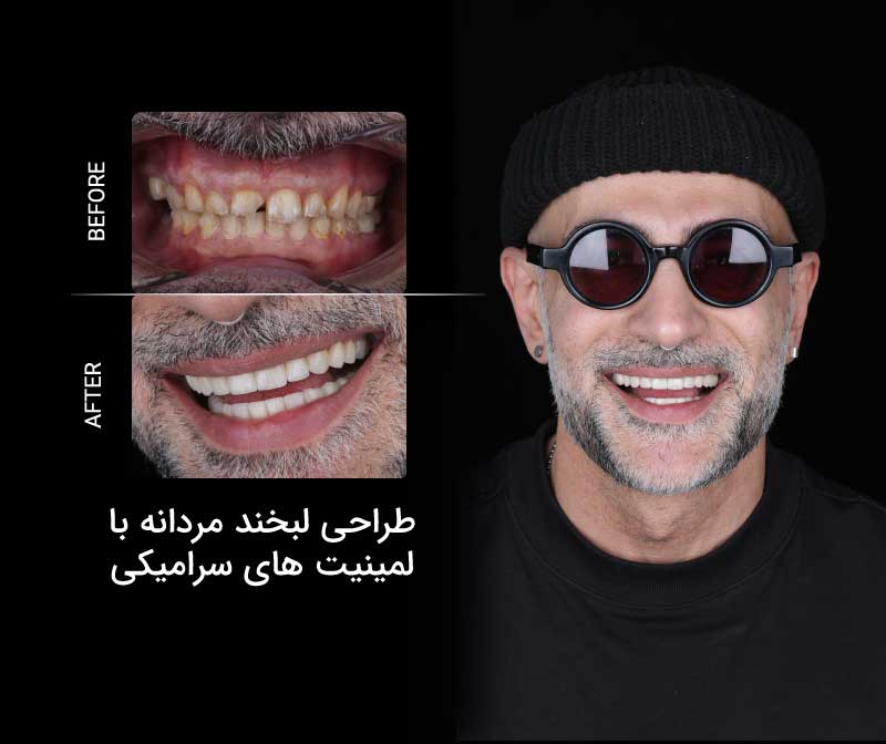مراحل طراحی و اصلاح لبخند چگونه است؟