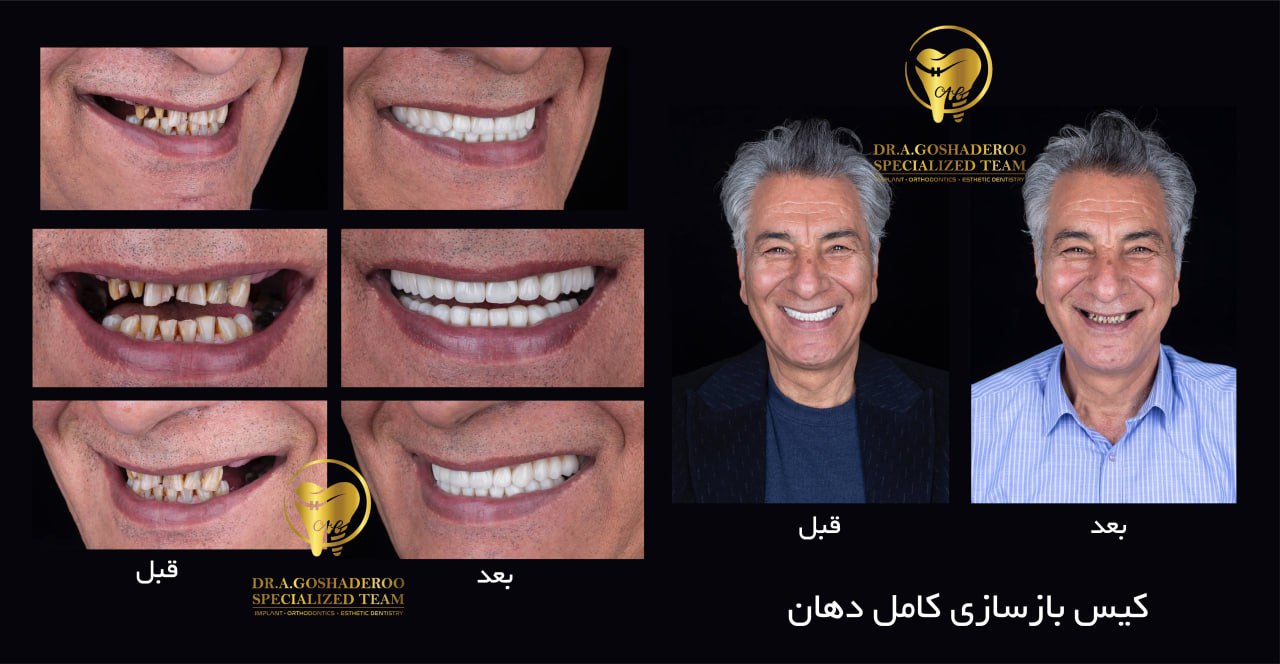 ایمپلنت