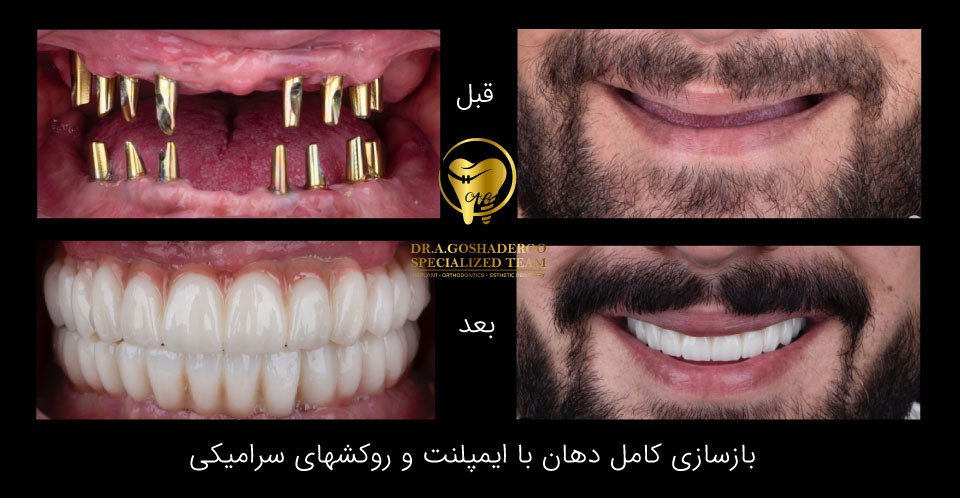 ایمپلنت