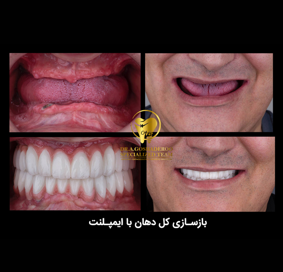 ایمپلنت
