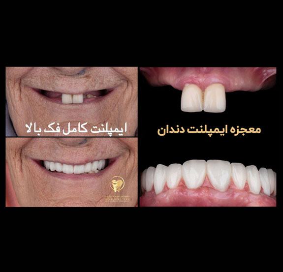 ایمپلنت