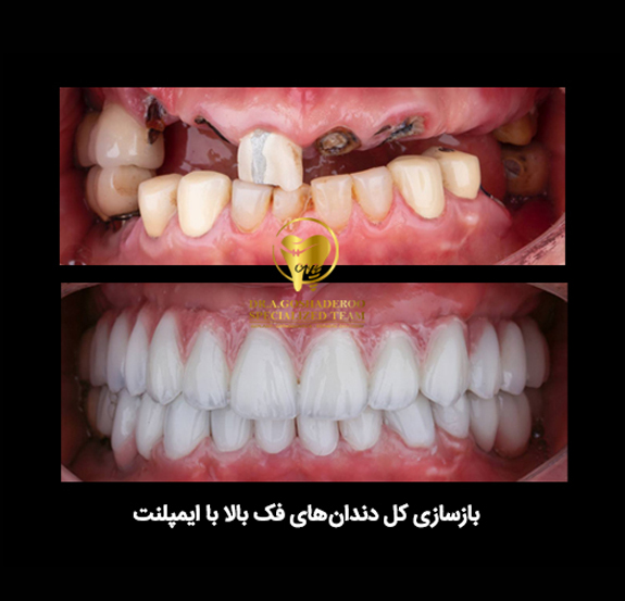ایمپلنت