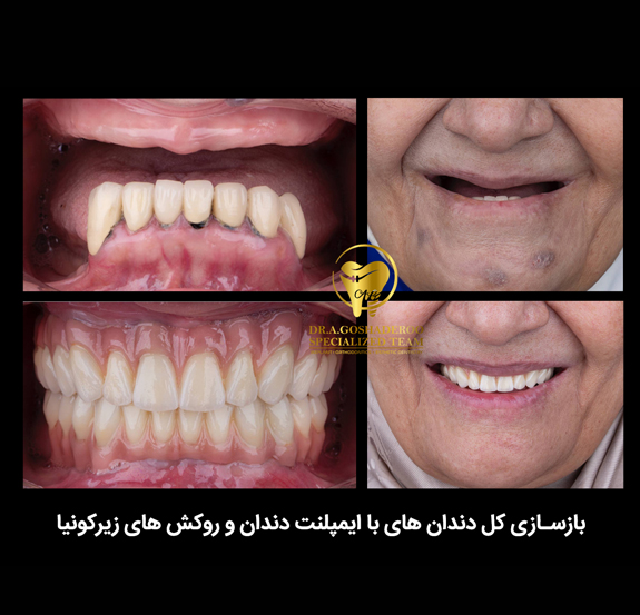ایمپلنت