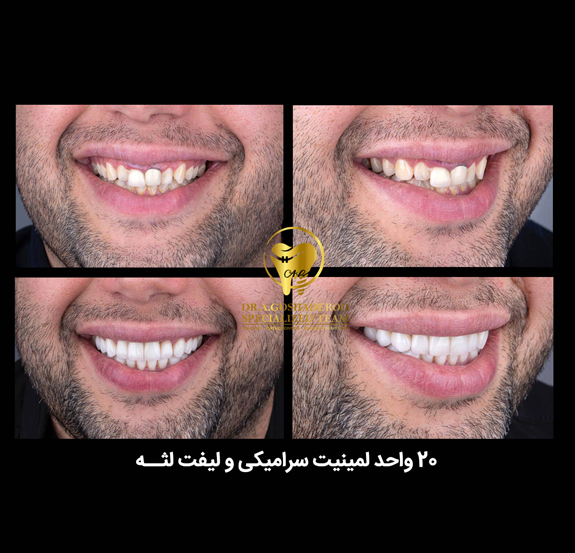 20 واحد لمینیت سرامیکی و لیفت لثه