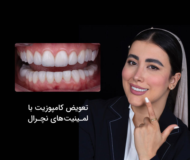 ایمپلنت