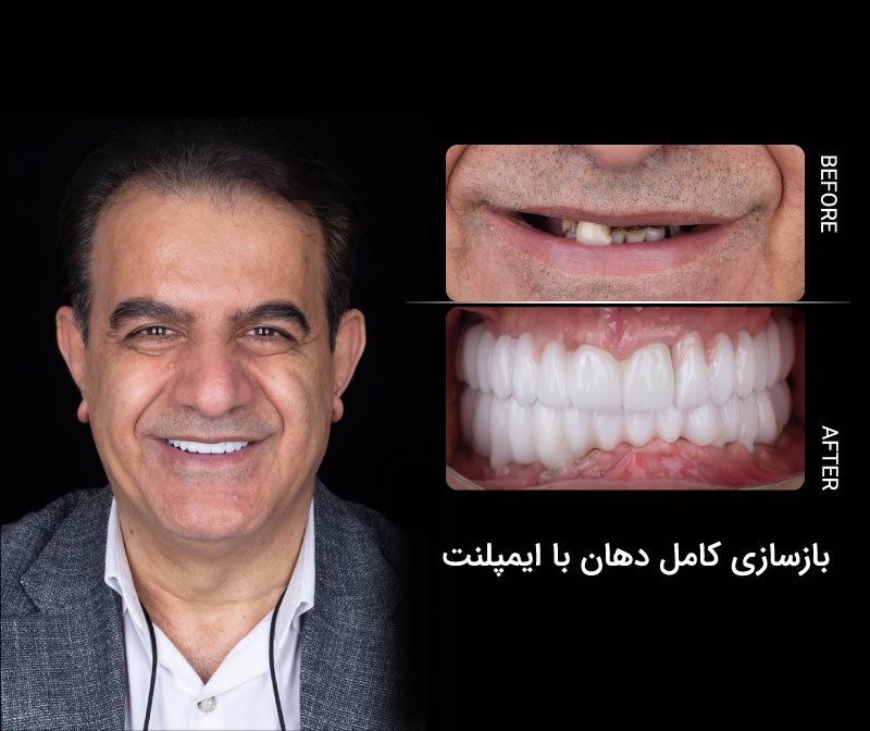 ایمپلنت