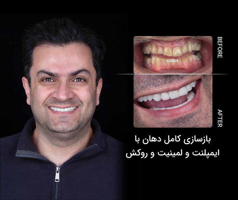 ایمپلنت