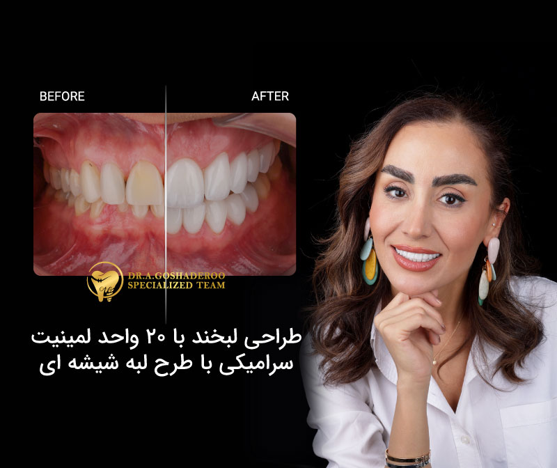 طراحی لبخند با 20 واحد لمینیت سرامیکی با طرح لبه شیشه ای