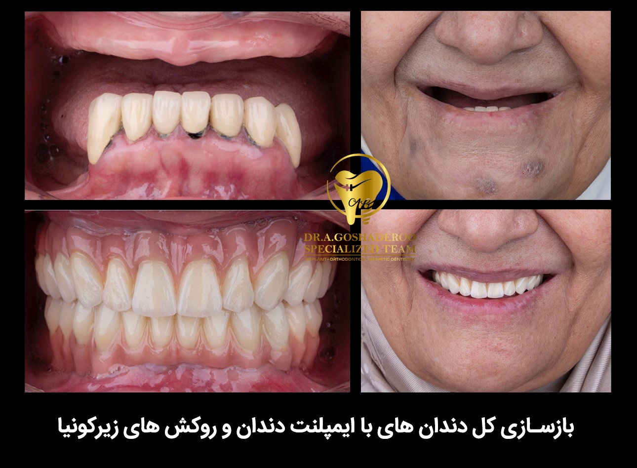 بازسازی کامل دندانها با ایمپلنت و روکشهای سرامیکی