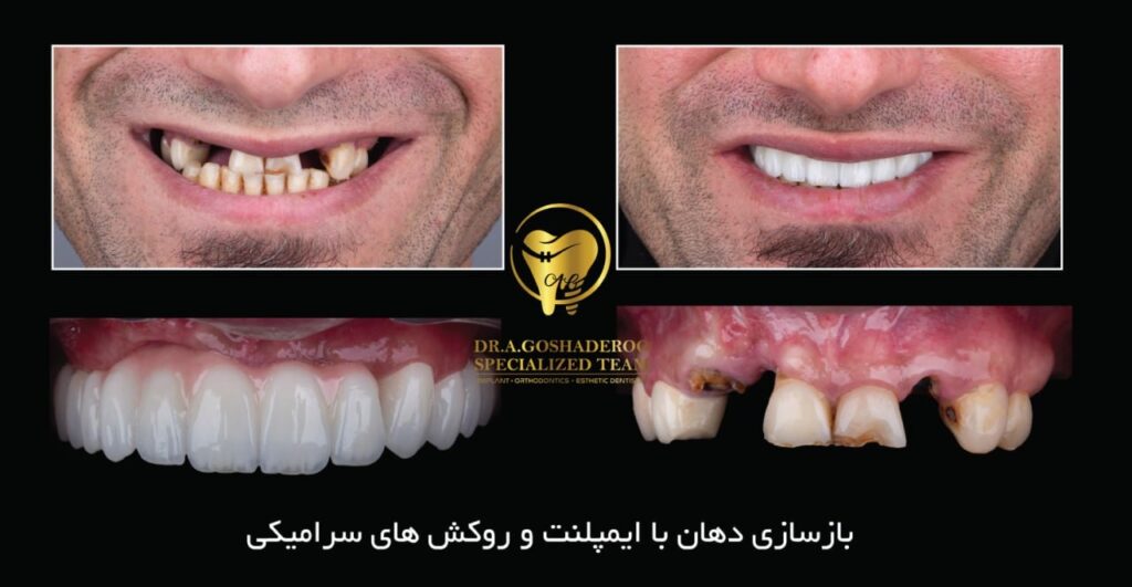 بازسازی دهان با ایمپلنت و روکش سرامیکی