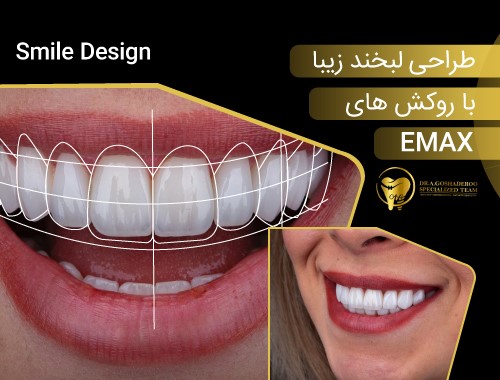 طراحی لبخند با روکش ایمکس
