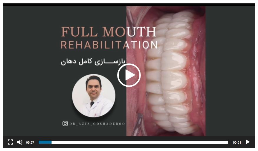 بازسازی کامل دهان و معجزه ایمپلنت