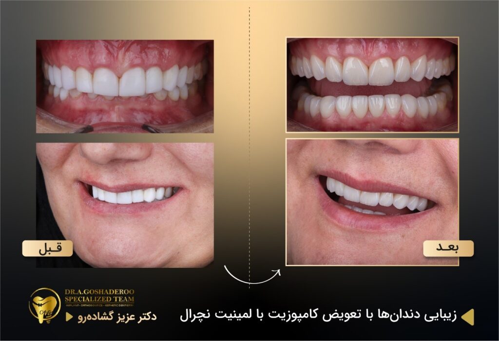 تعویض کامپوزیت با لمینت&zwnj;