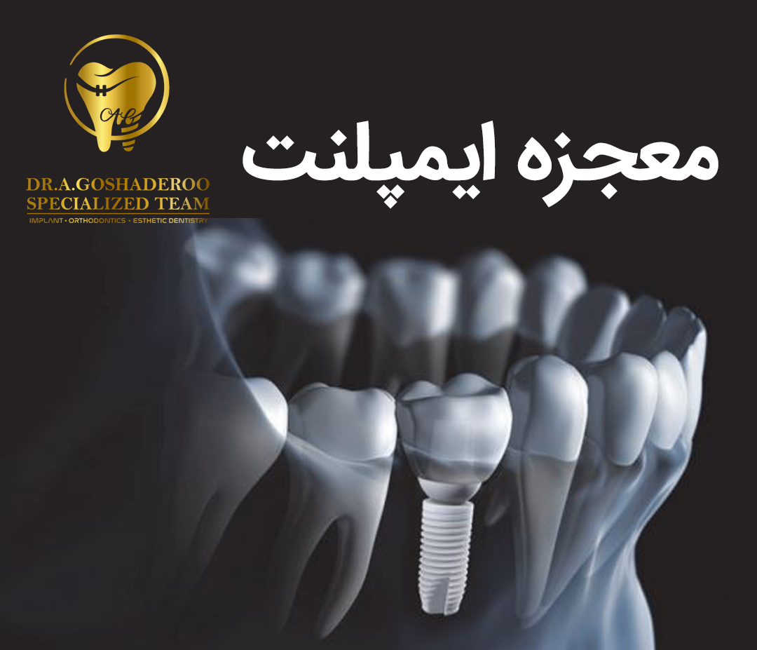 معجزه ایمپلنت در بازسازی فک و دهان  چگونه است؟