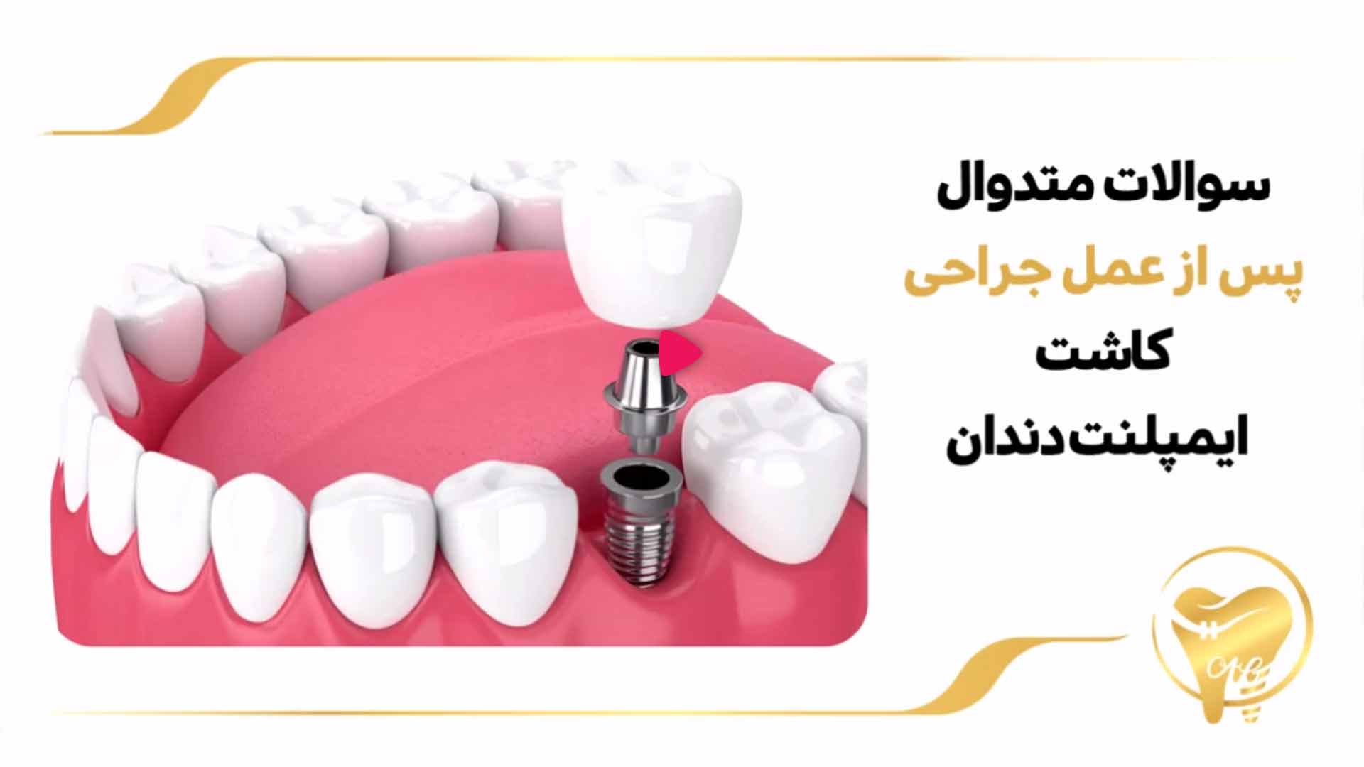 سوالات متداول پس از عمل جراحی کاشت ایمپلنت دندان
