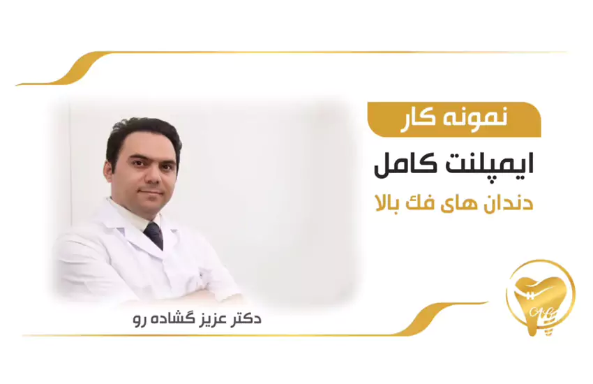 ایمپلنت کامل فک بالا
