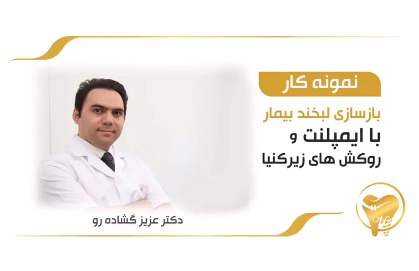 بازسازی لبخند بیمار با ایمپلنت و روکشهای زیرکونیا