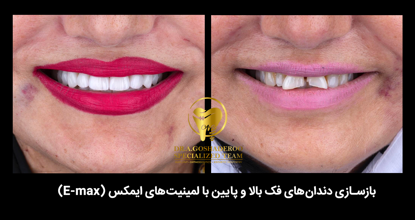 پس از شکسته شدن یا افتادن لمینت چه کنیم؟