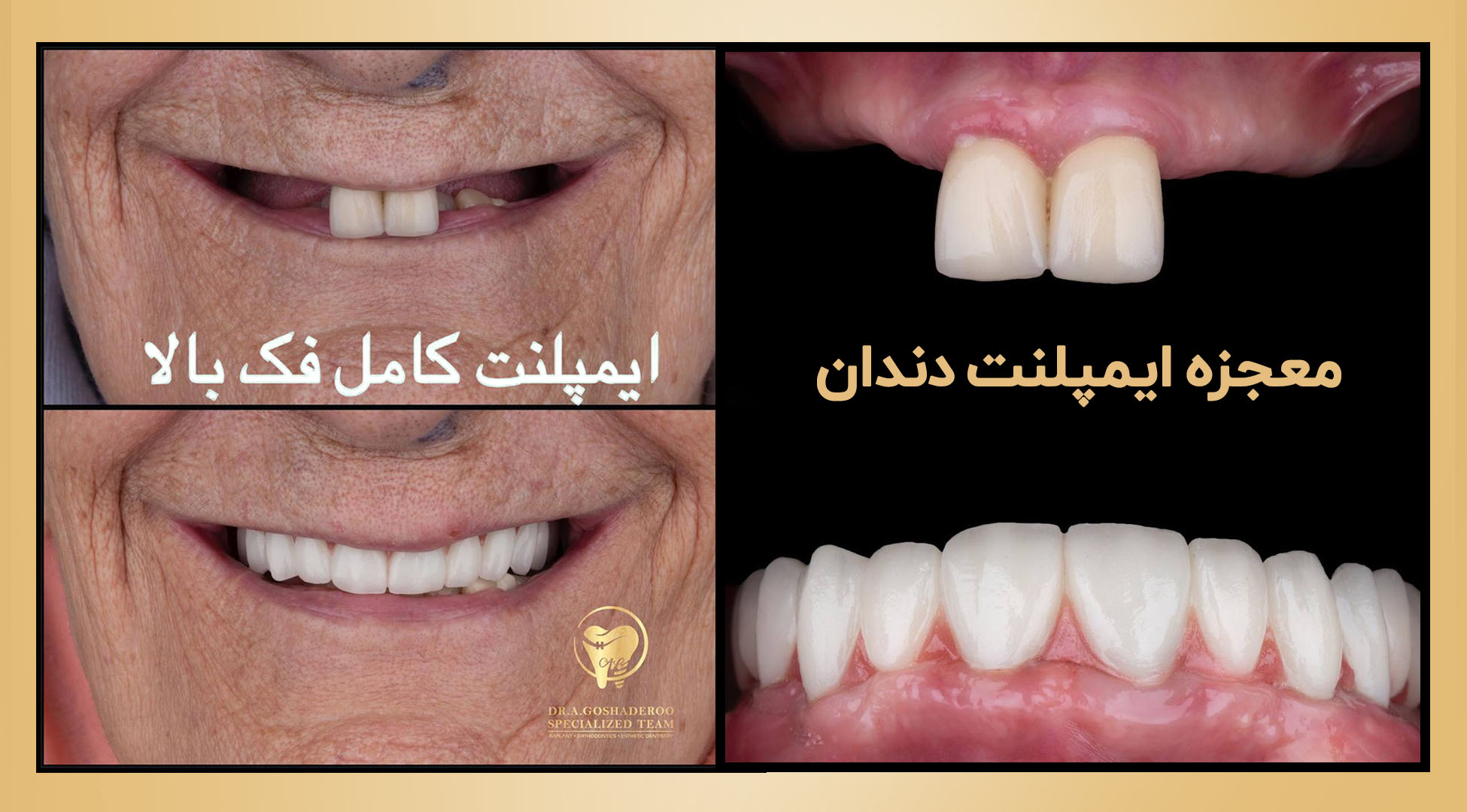 ایمپلنت فوری دندان ایمپلنت دندان جلو