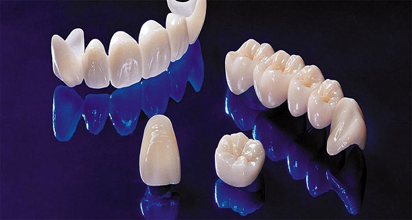 emax-laminate-advantages