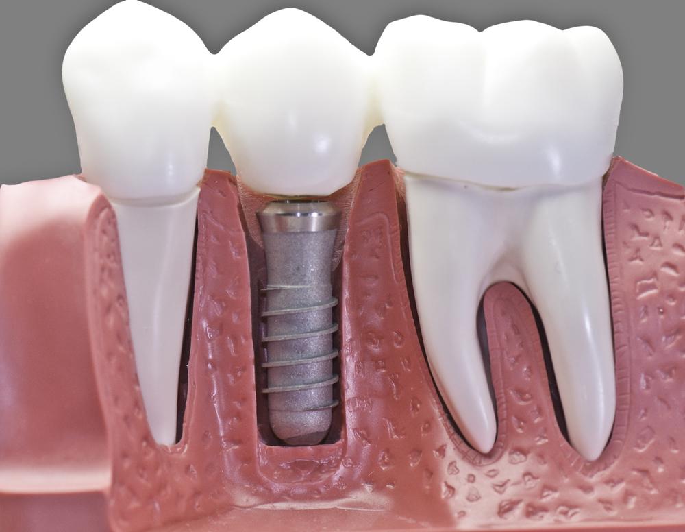 ایمپلنت فوری یک روزه