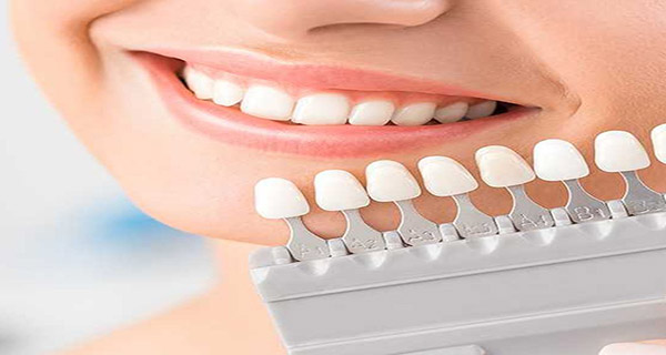 لمینت و روکش ایمکس(E-max)
