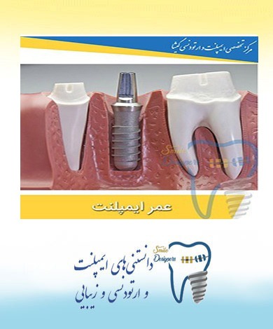 طول عمر ایمپلنت دندان ( کاشت دندان)