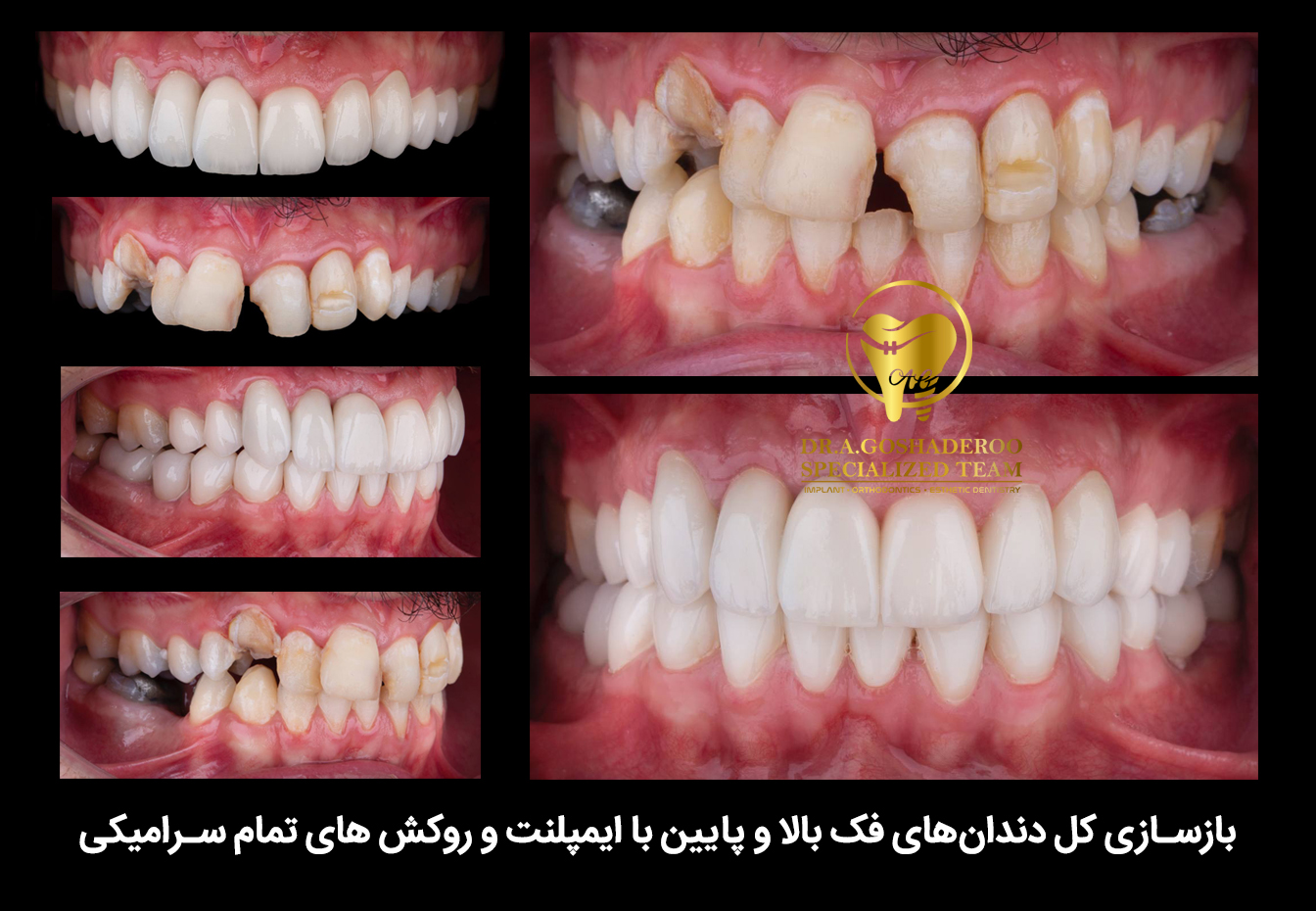 نمونه درمان فول ایمپلنت دو فک و بازسازی دندان&zwnj;ها توسط دکتر عزیز گشاده&zwnj;رو