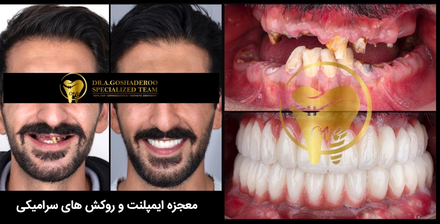 متخصص ایمپلنت در الهیه _ دکتر عزیز گشاده رو