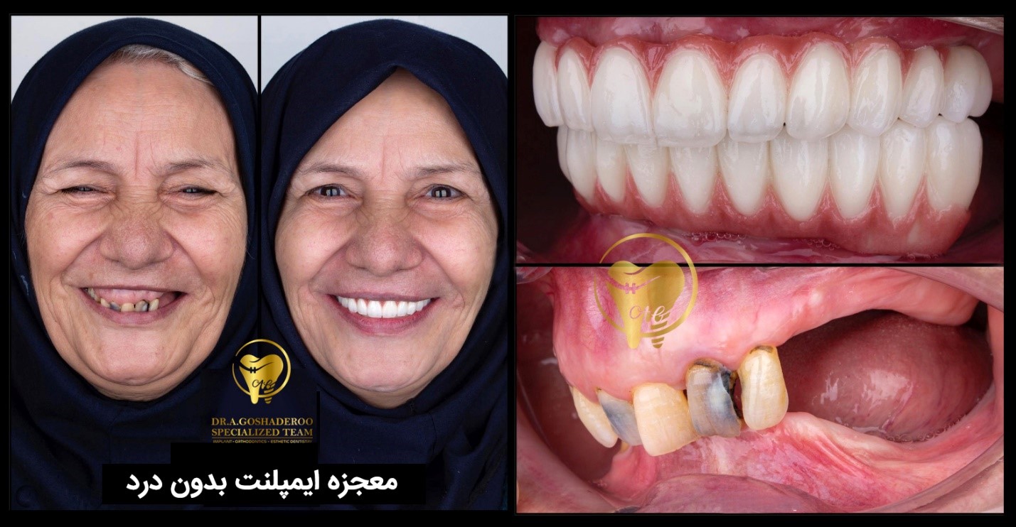 بهترین متخصص ایمپلنت دندان در الهیه _ دکتر عزیز گشاده رو