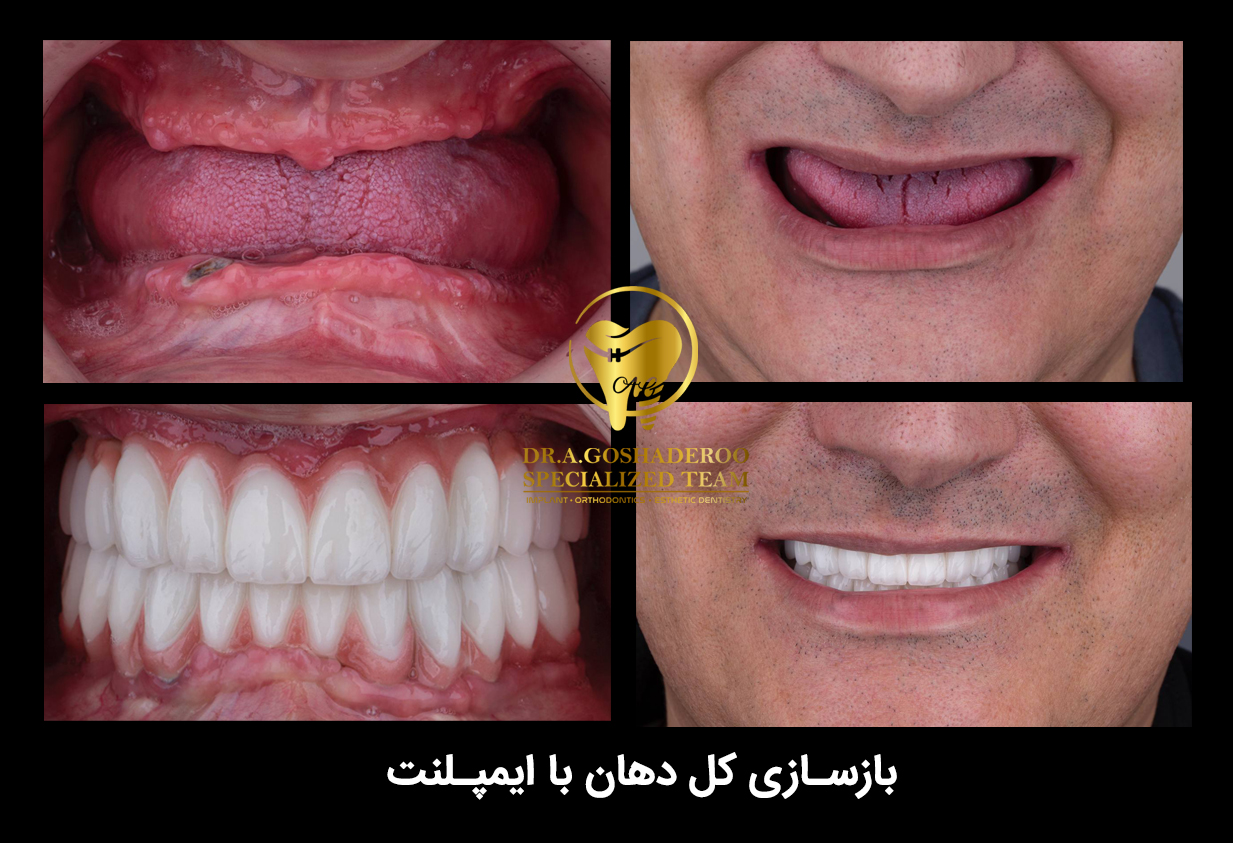 ایمپلنت های دندانی چگونه می توانند زندگی افراد را تغییر دهند؟
