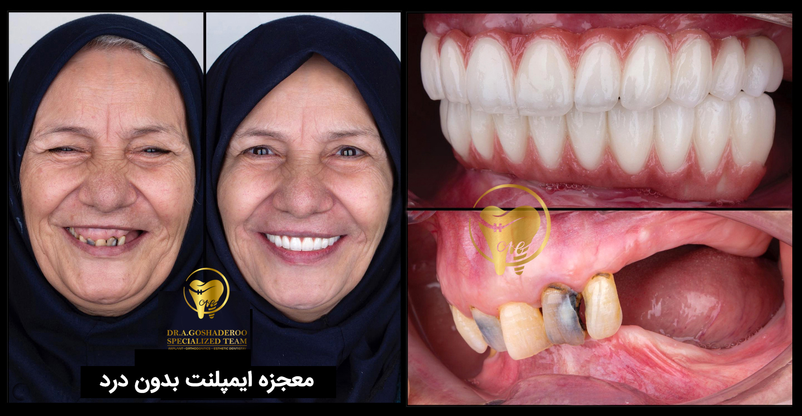 بازسازی کل دندانها با ایمپلنت و روکش و لمینیتهای سرامیکی