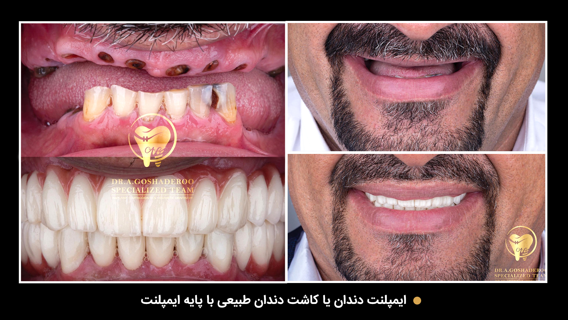 کاشت ایمپلنت دندان
