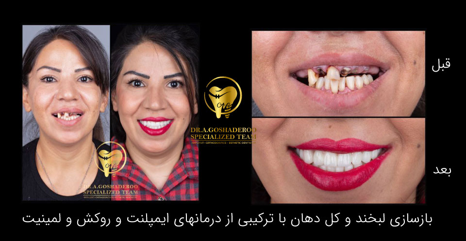 بازسازی کل دهان با ترکیبی از درمان های ایمپلنت ، روکش و لمینیت