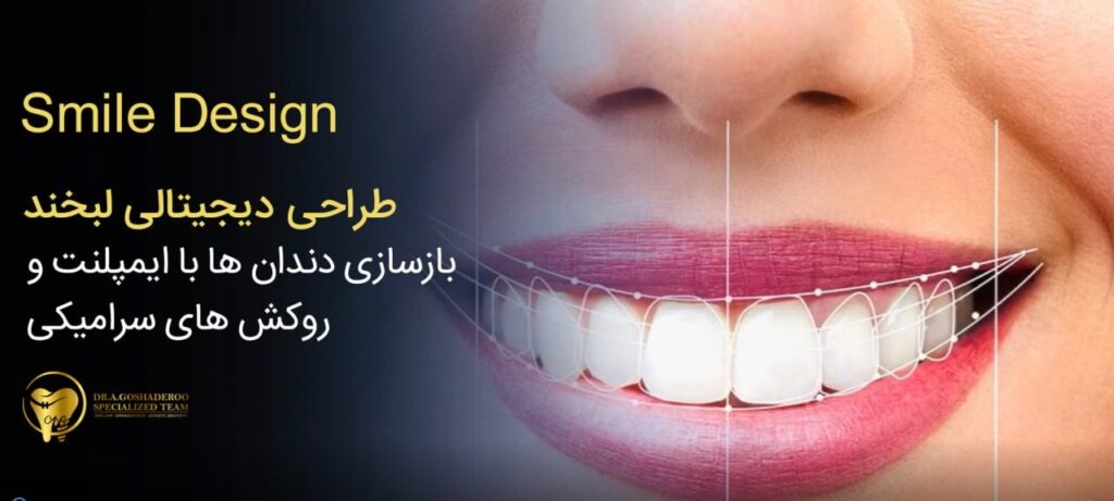 طراحی لبخند دیجیتال توسط متخصص پروتزهای دندانی
