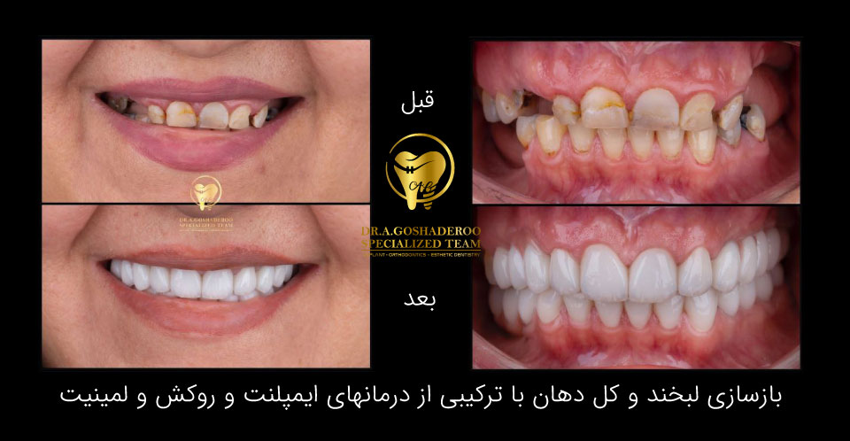 بازسازی لبخند با ترکیبی از درمان های ایمپلنت و روکش و لمینیت