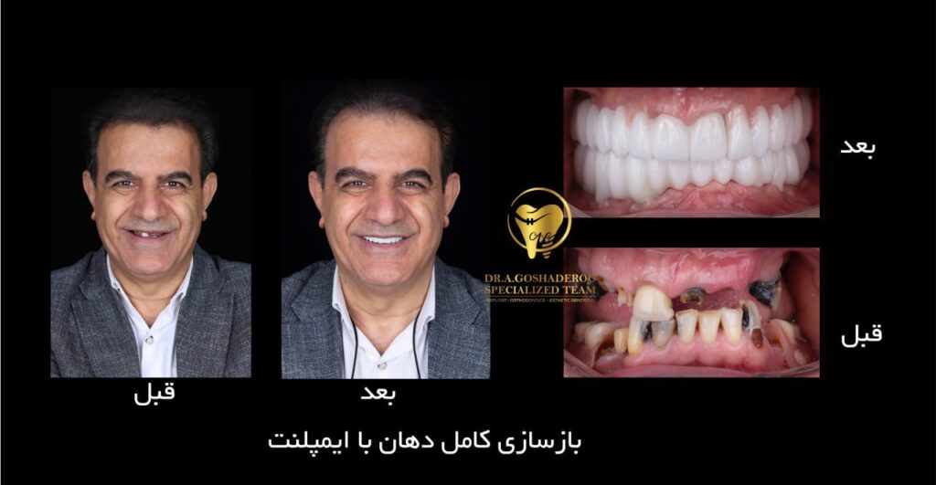 بازسازی کامل دهان با ایمپلنت