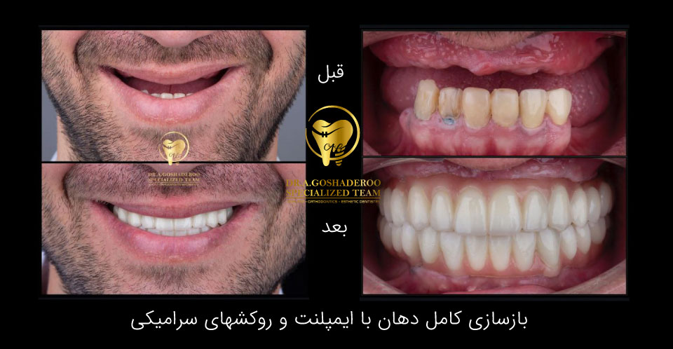 بازسازی کامل دهان با ایمپلنت و روک های سرامیکی