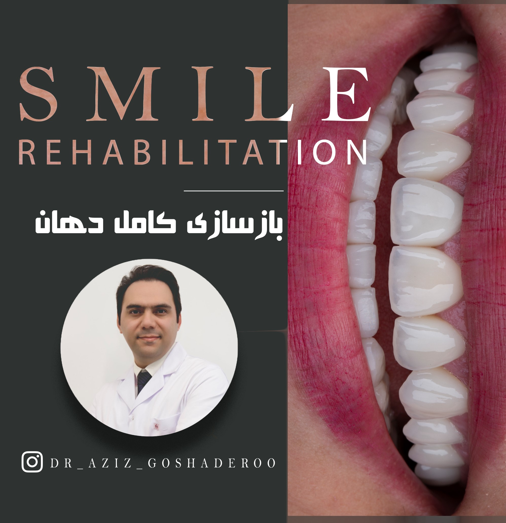 بازسازی کامل دهان _ درمان سینوس لیفت دوطرفه