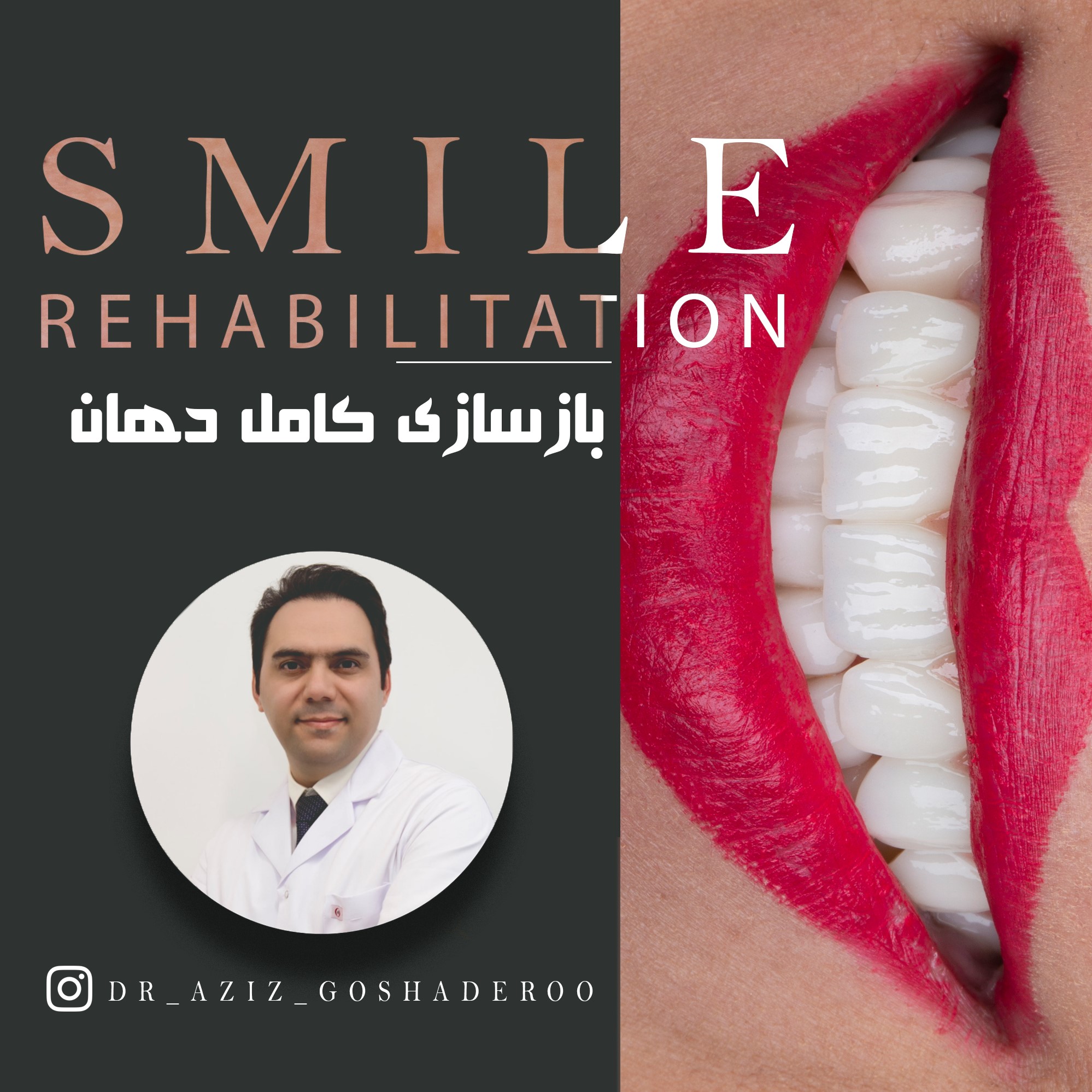 بازسازی لبخند با درمان های ترکیبی _ ایمپلنت و روکش و لمینیت