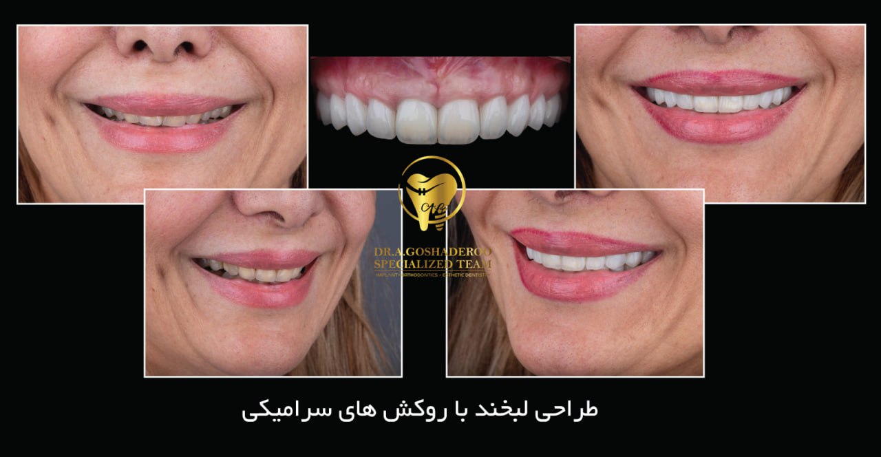 نمونه درمان طراحی لبخند با روکش سرامیکی