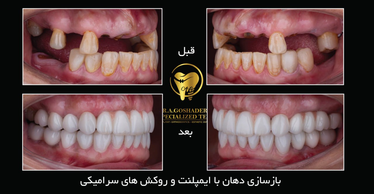 ایمپلنت دندان در تهران