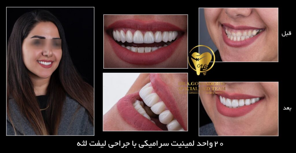 لیفت لثه با لمینیت سرامیکی
